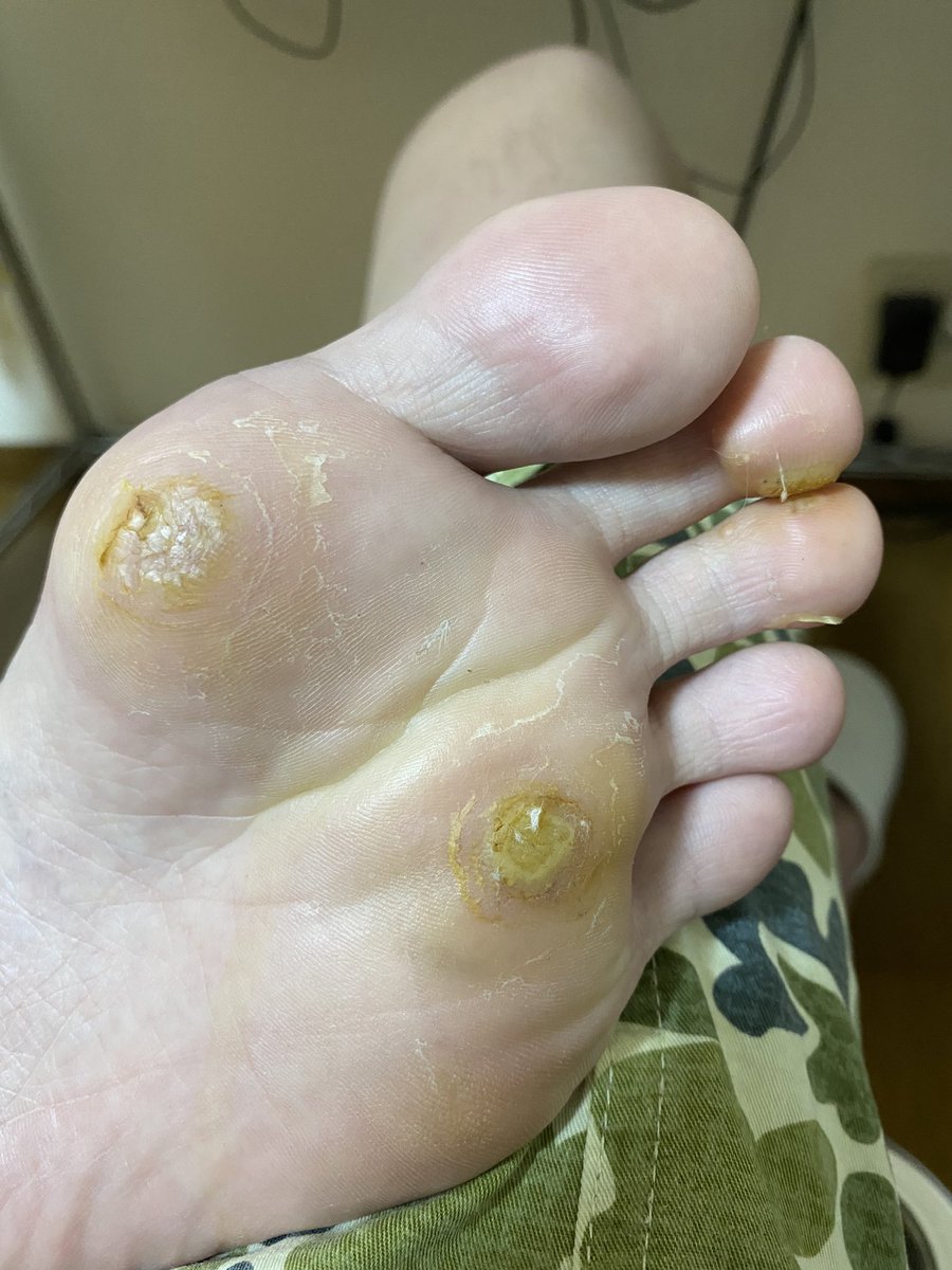 ウイルス性イボ Twitter ಹ ಡ ಕ ಟ ウイルス性イボ Twitter ಹ ಡ ಕ ಟ