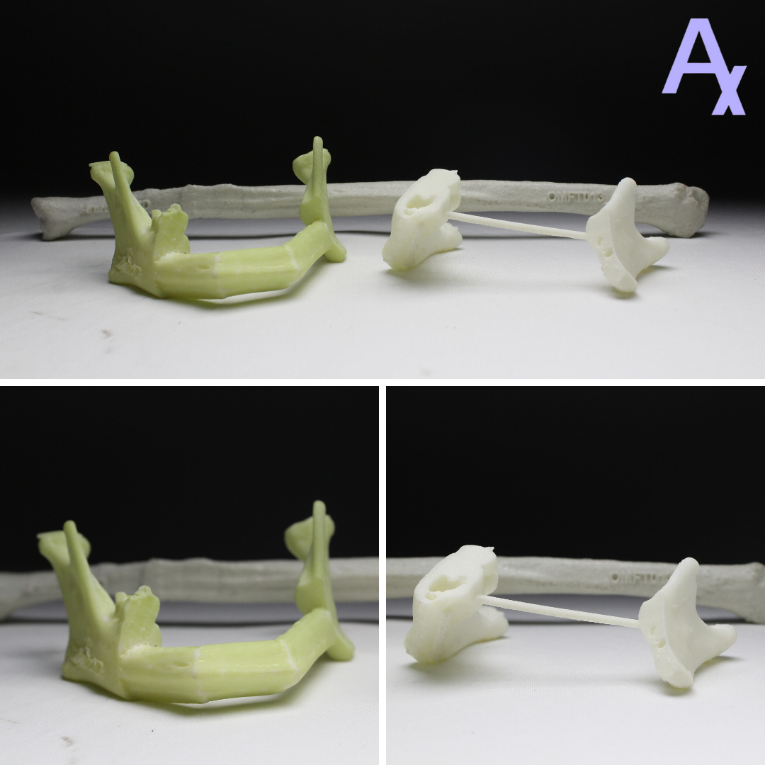 Anatomiz3D's tweet photo. An osteotomy was to be performed, using the fibula, for the tumour affected mandible. The fibula was segmented and then arranged on the cut section of the mandible to replicate it. To perform this, cutting guides were provided for a precise osteotomy.

#Healthcare #3DPrinting https://t.co/FfOLlas4BU
