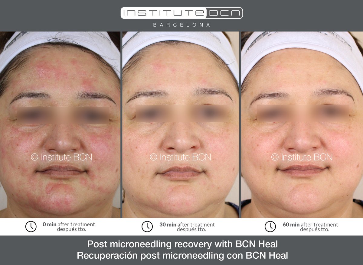 bcnmesotherapy's tweet photo. Increíbles resultados | Amazing results
#institutebcn #microneedling #aestheticlab #mesotherapy https://t.co/rDAfONA5ZT