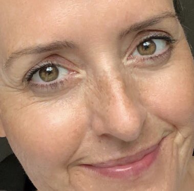 GayleOBrien's tweet photo. The look of rellief, right after getting mole mapped yesterday. Full body scan, including the soles of my feet, to check for skin cancer. Details coming up before 8a on the #MorningBuzz @1075daverocks

#frecklesforever😊 https://t.co/xMAJOXK88B