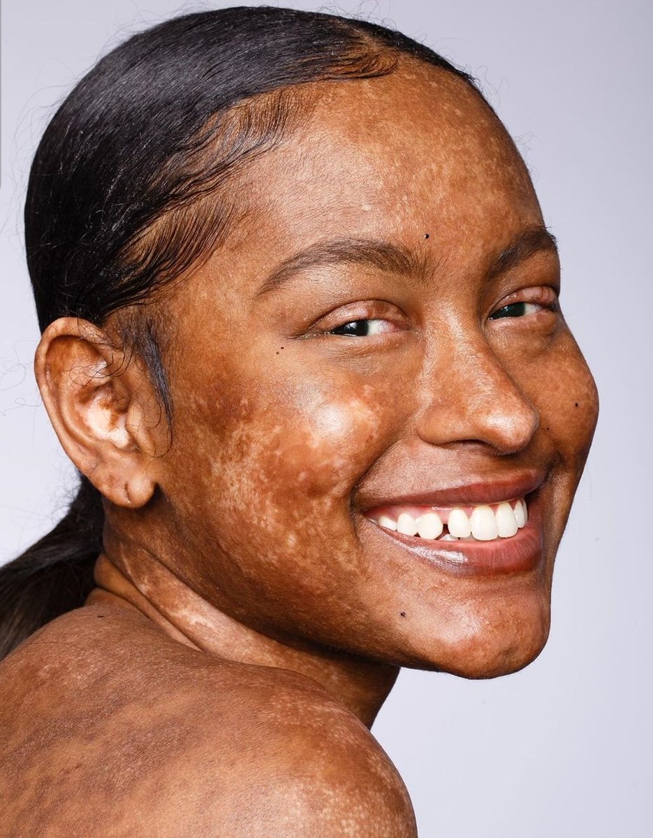 AthiMtongana's tweet photo. 22-year Amber from Atlanta, Georgia (USA) has a one in 2 million underlying condition. It is triggered by toxic epidermal necrolysis (TEN), read her story below. #BeComfortableInYourSkin https://t.co/WakVjv4bxF
