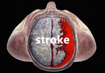 ctnsd_editor's tweet photo. #CTNSD [Study Protocol] 68 Ga-BNOTA-PRGD2 PET/CT for evaluation of post-stroke angiogenesis: study protocol for a prospective open-label clinical trial
#stroke #angiogenesis

https://t.co/pnloyoH5GX https://t.co/dlhKJ8FzU2