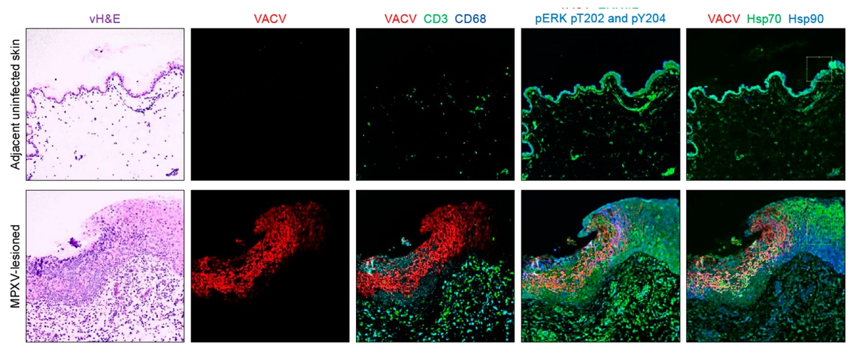 VirusesMDPI's tweet photo. Comparison of Multiplexed Immunofluorescence #Imaging to Chromogenic Immunohistochemistry of Skin Biomarkers in Response to #Monkeypox_Virus Infection. Read full text here: https://t.co/r7u56w0GXF. https://t.co/yiALYsS1Ei