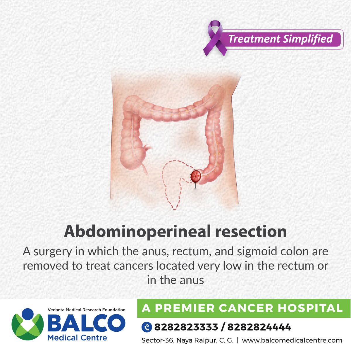 BalcoMedical's tweet photo. Surgery is the cornerstone in #rectalcancer treatment. If it is located close to the anus, sometimes the anus and nearby areas must be removed with the #cancer in a #surgery called an abdominoperineal resection. #TreatmentSimplified #workingtowardscancerfreesociety #cancercare https://t.co/4oxMlrK8vi