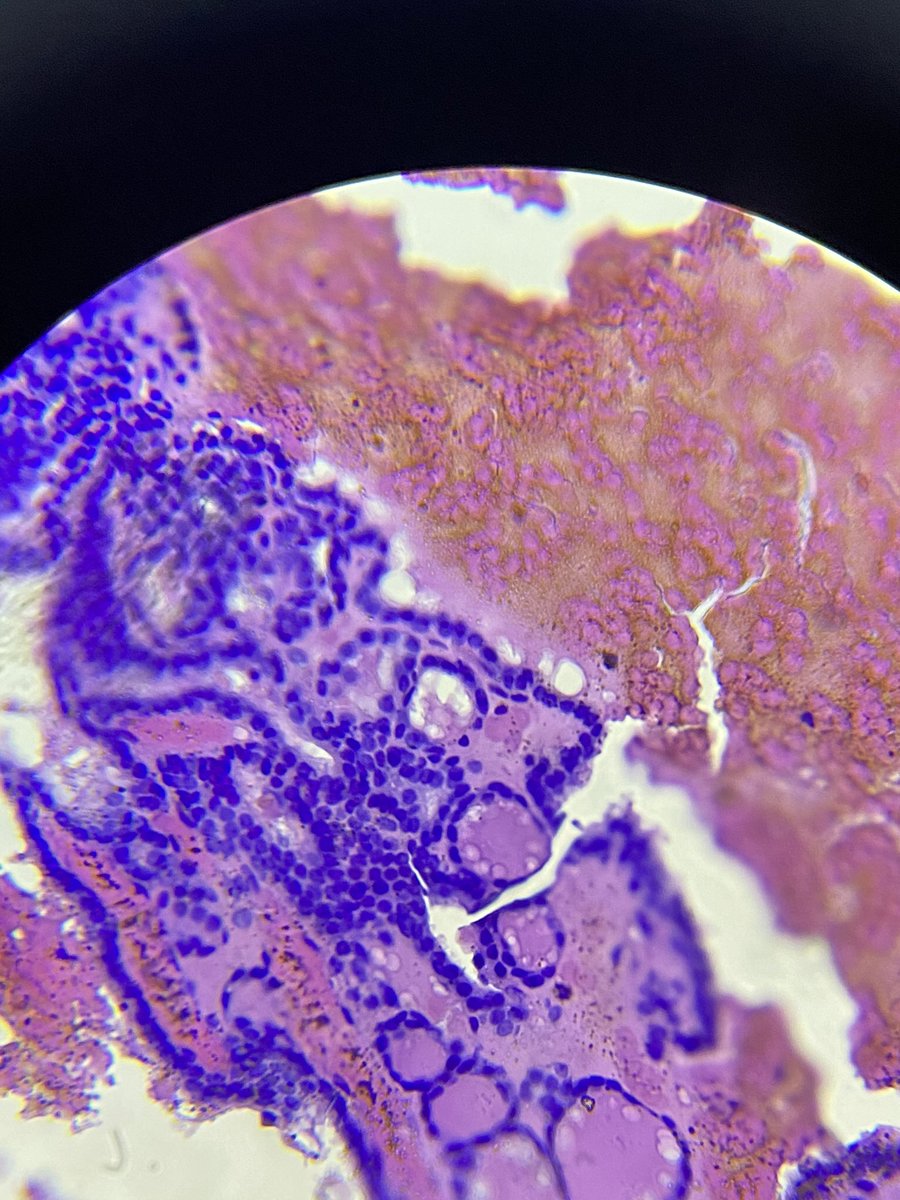 PiranSara's tweet photo. 30 female In ultrasound: Single well defined nodule With multiple cystic changes measure 2.4X 1.7 cm nearly occupying the whole Rt lobe. Cell block done for FNA for your opinions please #thyroidpathology #cytopathology #pathoboards #pathology https://t.co/mLZkAWLxNX