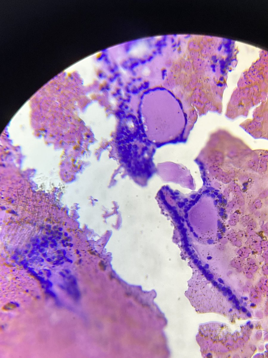 PiranSara's tweet photo. 30 female In ultrasound: Single well defined nodule With multiple cystic changes measure 2.4X 1.7 cm nearly occupying the whole Rt lobe. Cell block done for FNA for your opinions please #thyroidpathology #cytopathology #pathoboards #pathology https://t.co/mLZkAWLxNX