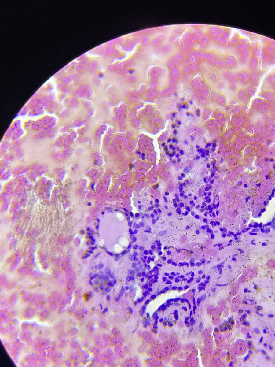 PiranSara's tweet photo. 30 female In ultrasound: Single well defined nodule With multiple cystic changes measure 2.4X 1.7 cm nearly occupying the whole Rt lobe. Cell block done for FNA for your opinions please #thyroidpathology #cytopathology #pathoboards #pathology https://t.co/mLZkAWLxNX