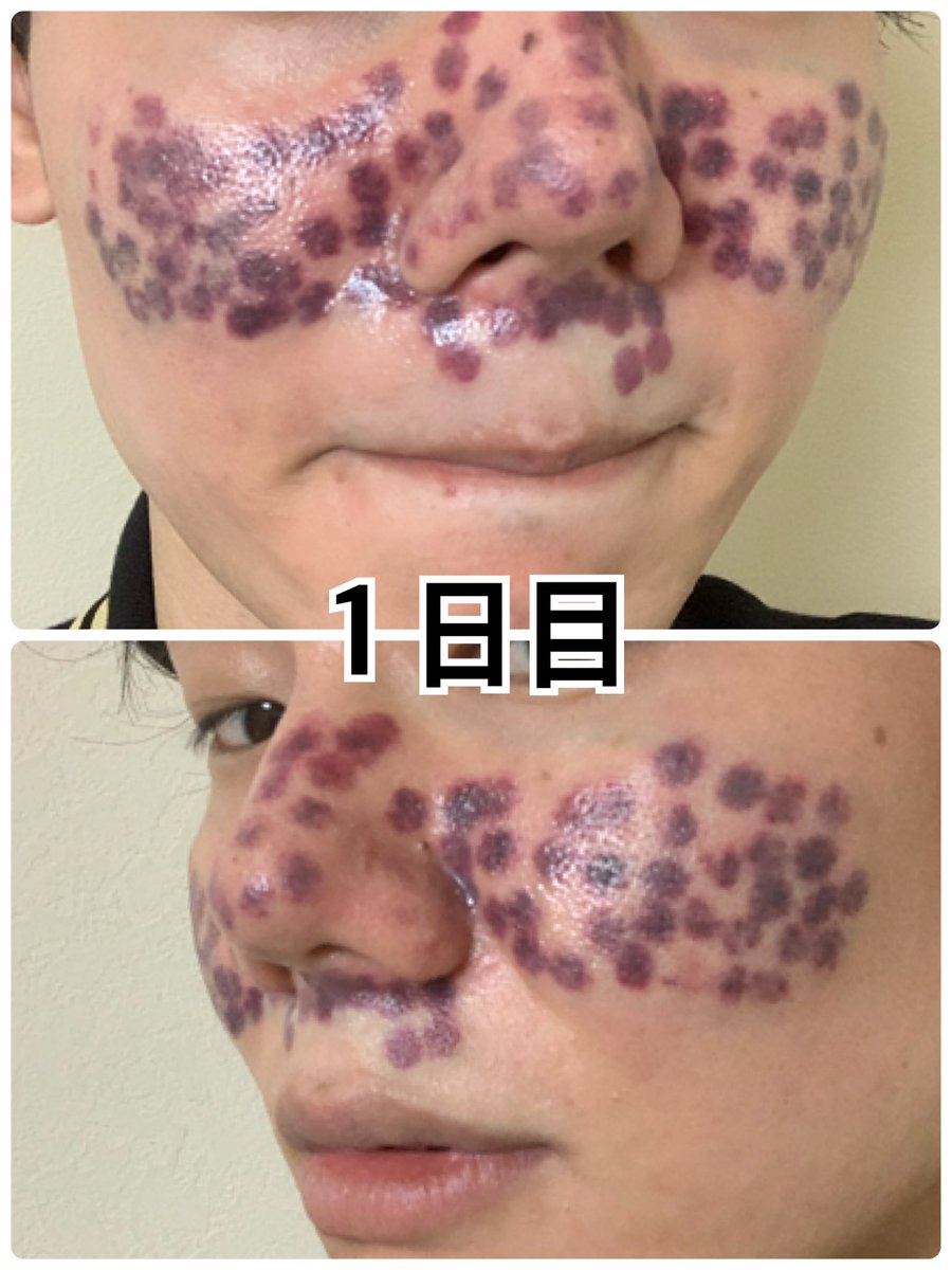 Vビームレーザー