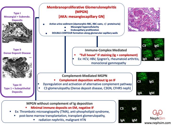 An approach to membranoproliferative #glomerulonephritis #MPGN ✳️ It's all about the IF ✳️ nephsim.com/image-gallery/ #FOAMed #MedEd