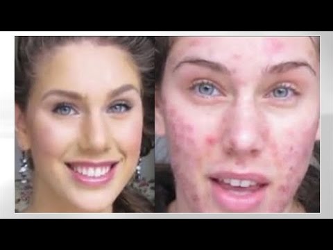 Good skin, straight teeth, slimmer face/body were all things I wanted.Medical insurance doesn't cover for a dermatologist (it's considered a cosmetic expense), so youtube became my guide! Elaine Mokk, Cassandra Bankson, & Melanie Murphy were my favorites back in the day