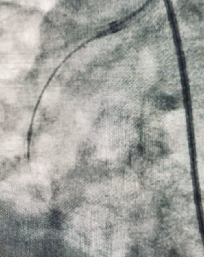 w_jyg's tweet photo. 9 PCI today include 2 Orbital Artherectomy , all done via RADIAL!!!
#RadialFirst π€π»
#FitIn7FrSheath
#LeftRadial
#DiamondBack360 π
#CSICertified π https://t.co/ecmzE9hLUK