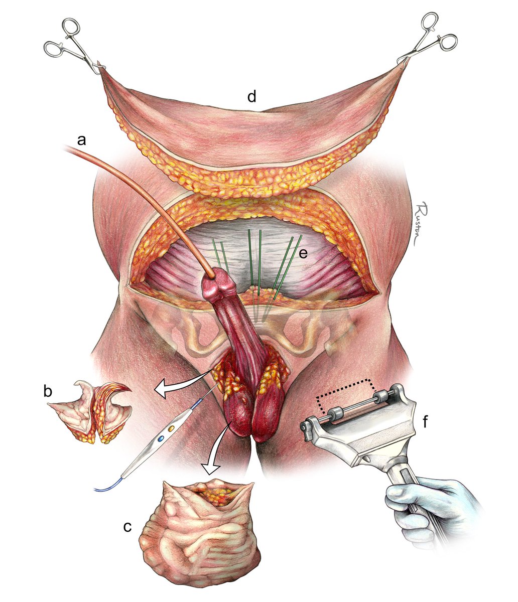 15/Reconstruction for AABP may necessitate debulking nearby tissues, releasing the penis from pathologic or physiologic entrapment, excising and replacing diseased soft tissue, and/or suspending the penis to prevent reburying.