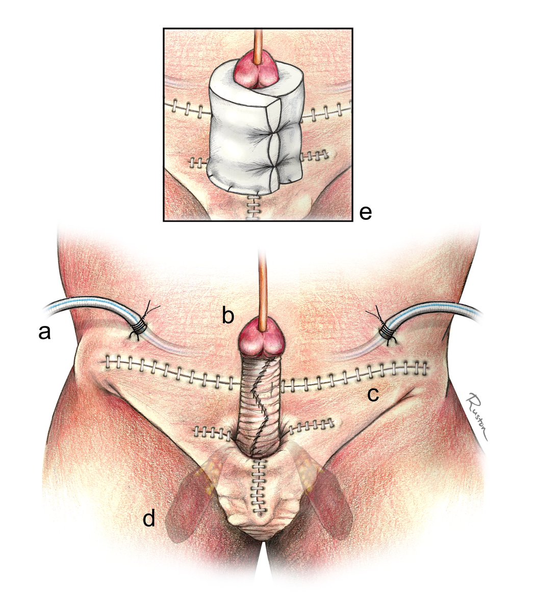 15/Reconstruction for AABP may necessitate debulking nearby tissues, releasing the penis from pathologic or physiologic entrapment, excising and replacing diseased soft tissue, and/or suspending the penis to prevent reburying.
