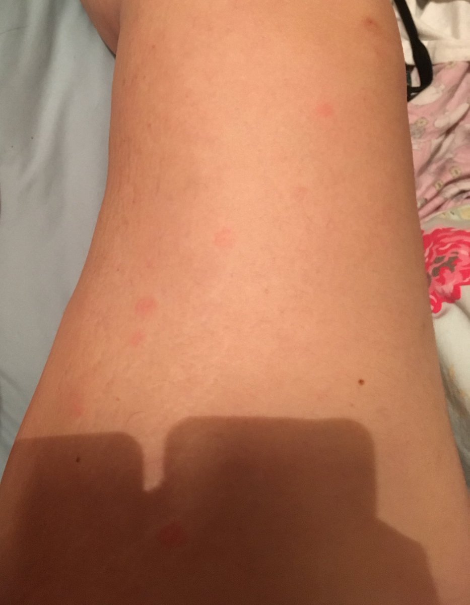 I started getting small hives on my legs in May 2019. I went to the GP and she said they were insect bites. I was very itchy, and some were breaking open and scabbing.