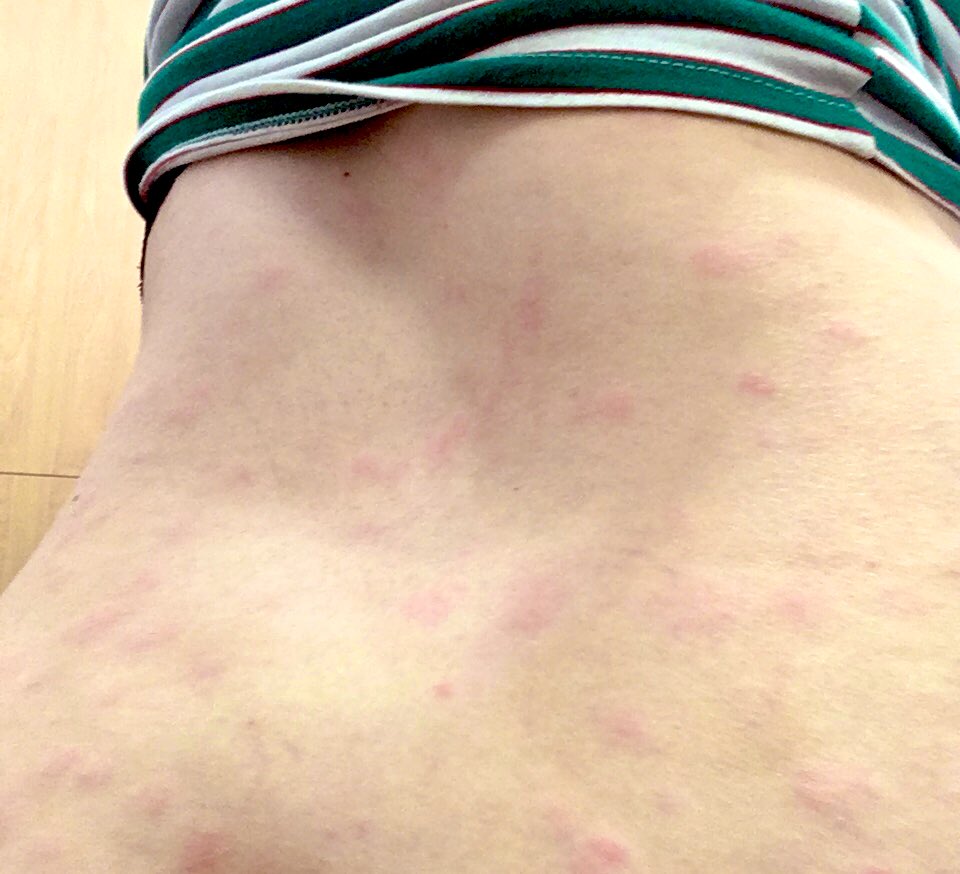 I stripped and disinfected my bed, closed my window, and they kept coming. They got bigger. The doctor said if I REALLY hadn’t changed anything (as if I was stubbornly washing my clothes with something I was allergic to) it was just hives. They put me on new antihistamines.