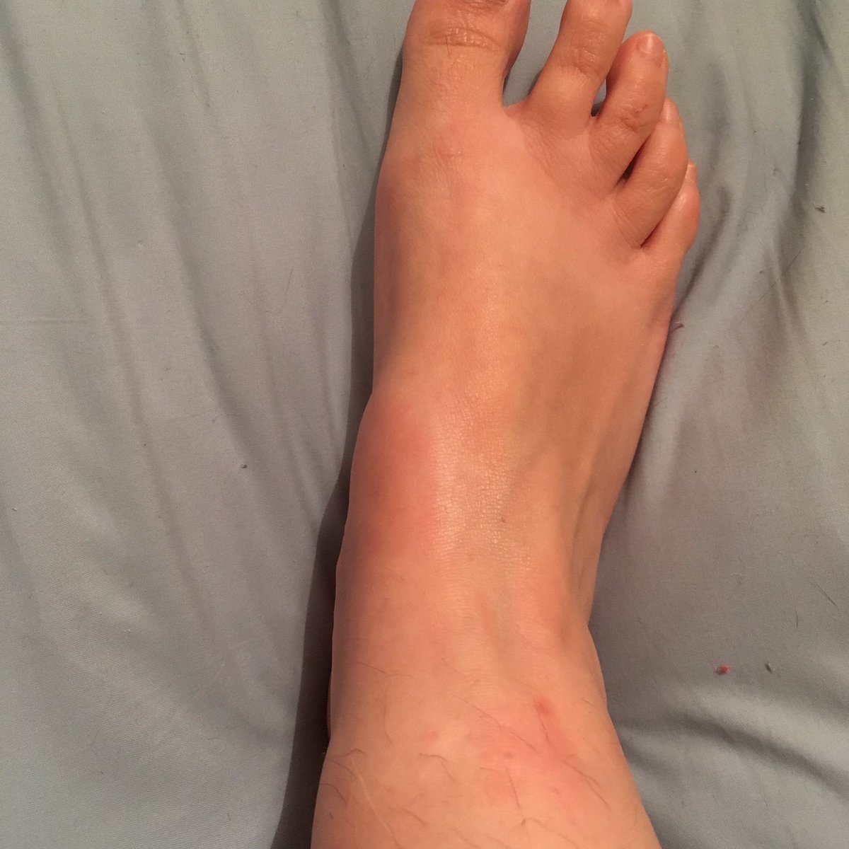 I took them for as long as they said, and the hives kept getting worse. They spread to my neck, my feet, and my fingers swelled up. They left behind pinprick marks, bruises, and discoloured patches. They hurt deep under the skin. I was given more antihistamines.