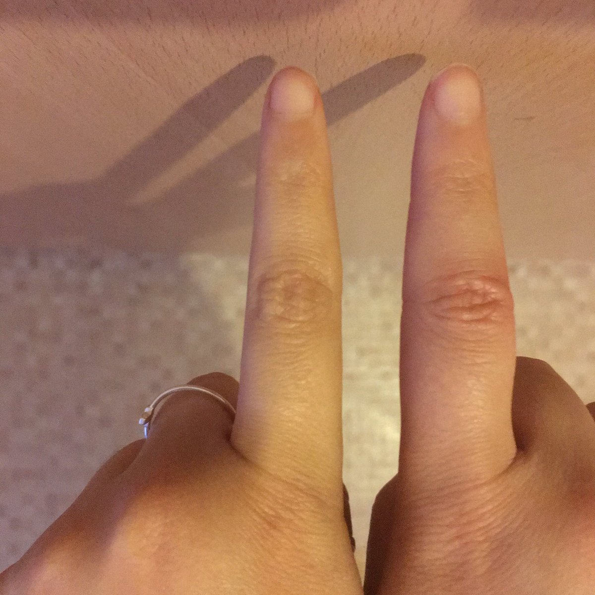 I took them for as long as they said, and the hives kept getting worse. They spread to my neck, my feet, and my fingers swelled up. They left behind pinprick marks, bruises, and discoloured patches. They hurt deep under the skin. I was given more antihistamines.