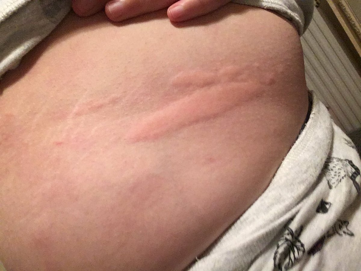 I took them for as long as they said, and the hives kept getting worse. They spread to my neck, my feet, and my fingers swelled up. They left behind pinprick marks, bruises, and discoloured patches. They hurt deep under the skin. I was given more antihistamines.