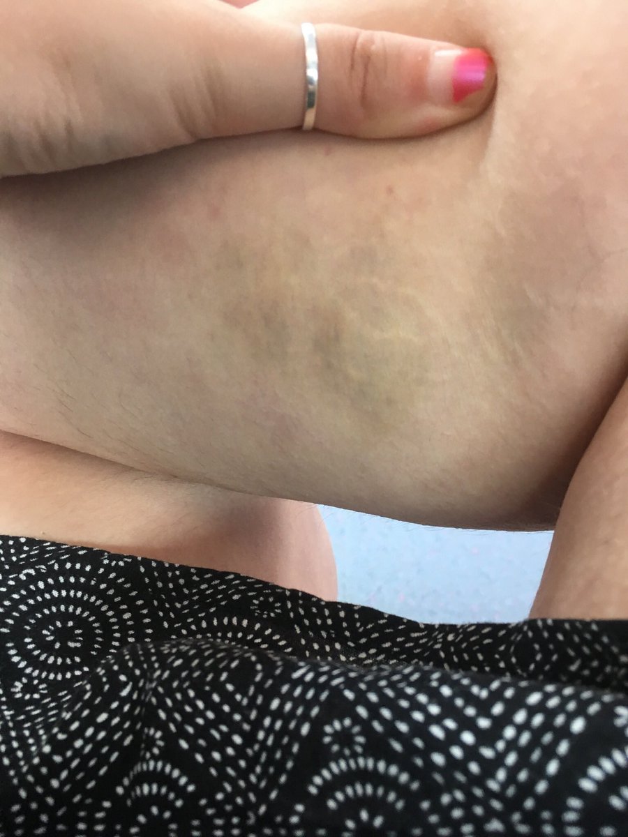 I took them for as long as they said, and the hives kept getting worse. They spread to my neck, my feet, and my fingers swelled up. They left behind pinprick marks, bruises, and discoloured patches. They hurt deep under the skin. I was given more antihistamines.