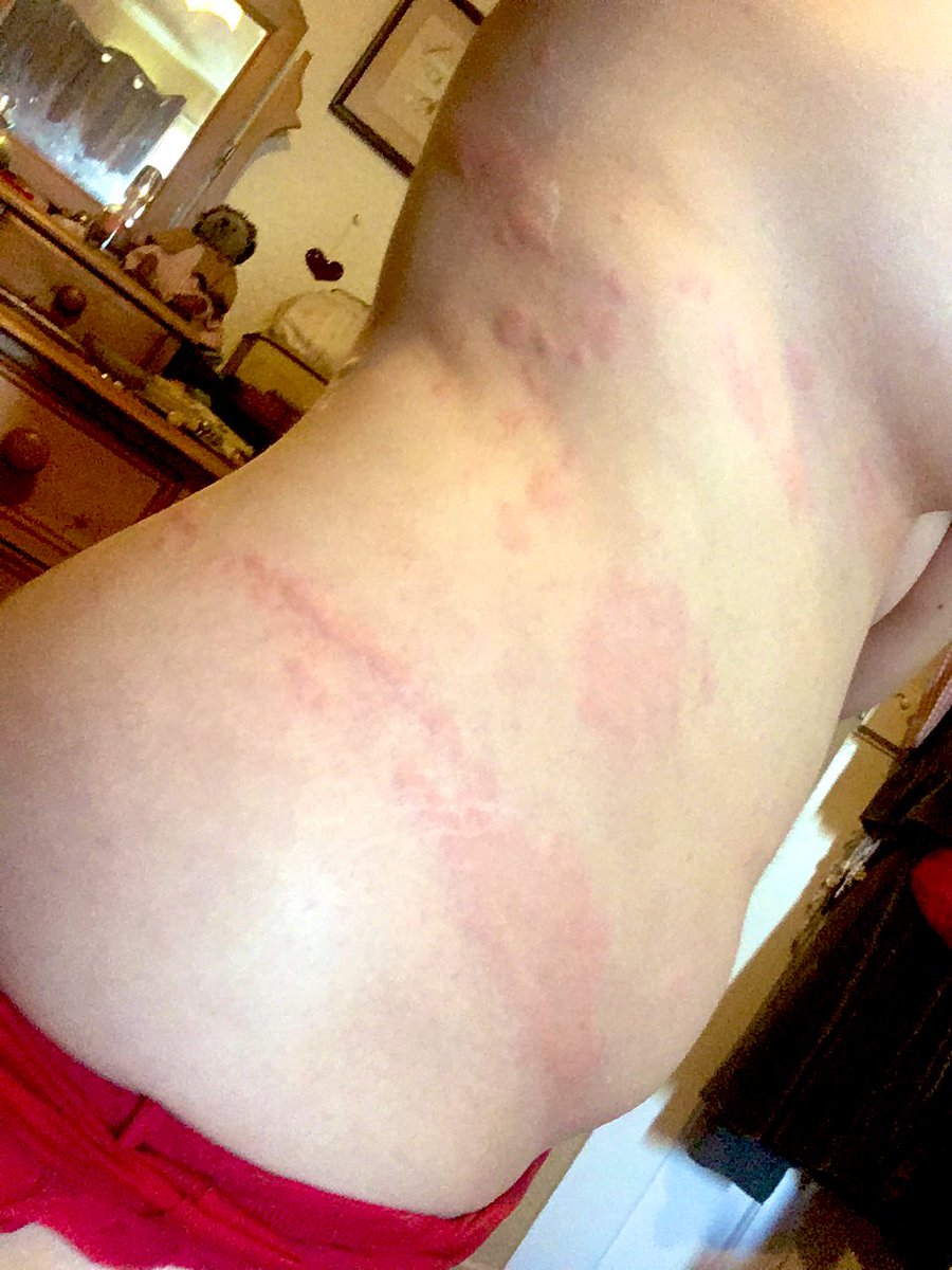 This was a month in. I was exhausted. I felt defeated. I went back to the doctors. They weren’t allowed to give me more steroids. I asked for a dermatology referral. The hives kept getting worse. They were on my face, my joints, and I could no longer wear underwear.