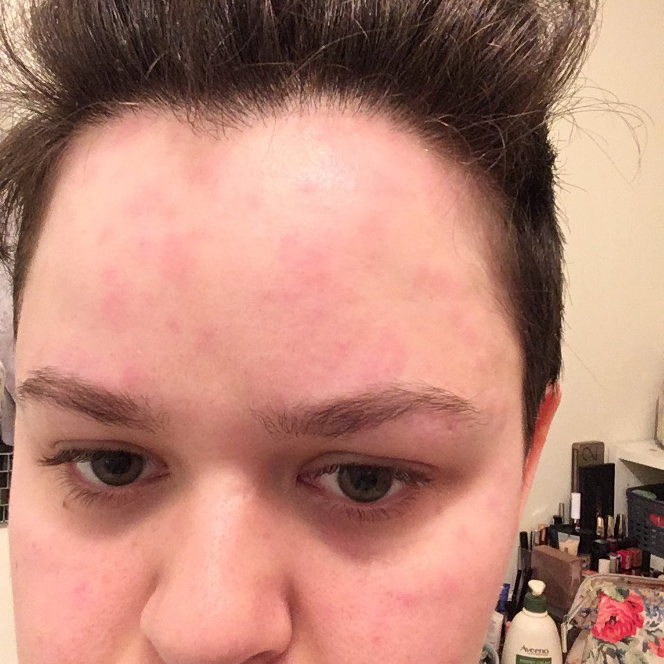 This was a month in. I was exhausted. I felt defeated. I went back to the doctors. They weren’t allowed to give me more steroids. I asked for a dermatology referral. The hives kept getting worse. They were on my face, my joints, and I could no longer wear underwear.