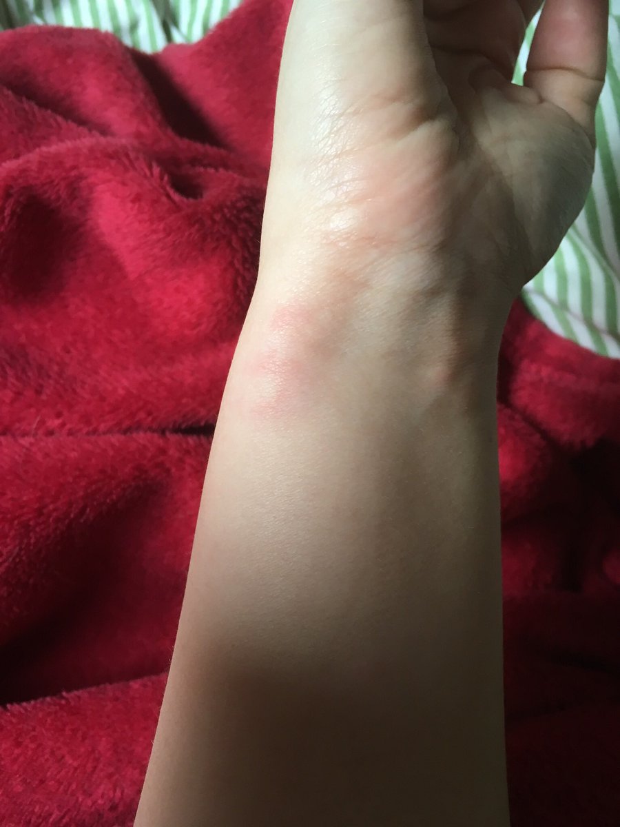 A week later the steroids ran out. I tapered over two days, like I was told to, and almost immediately after?