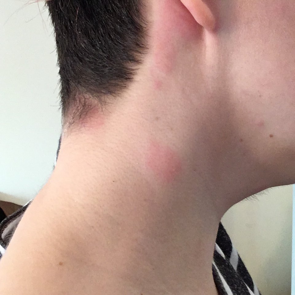 A week later the steroids ran out. I tapered over two days, like I was told to, and almost immediately after?