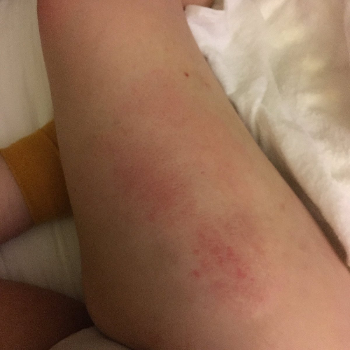 A week later the steroids ran out. I tapered over two days, like I was told to, and almost immediately after?