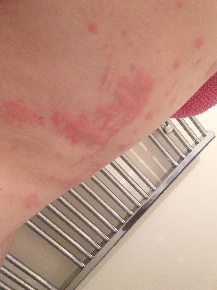 A week later the steroids ran out. I tapered over two days, like I was told to, and almost immediately after?