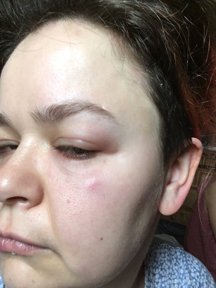 My eyes are not closed. They are swollen shut.