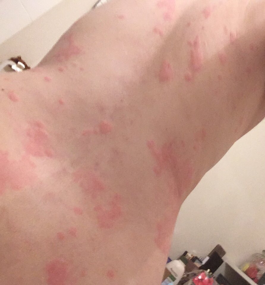 I went to stay with my mum, out of necessity. I needed to be looked after because I was unable to care for myself. The picture of my hand is how swollen my fingers were while travelling. I had to carry a damp flannel to ease the itching. I was delirious.