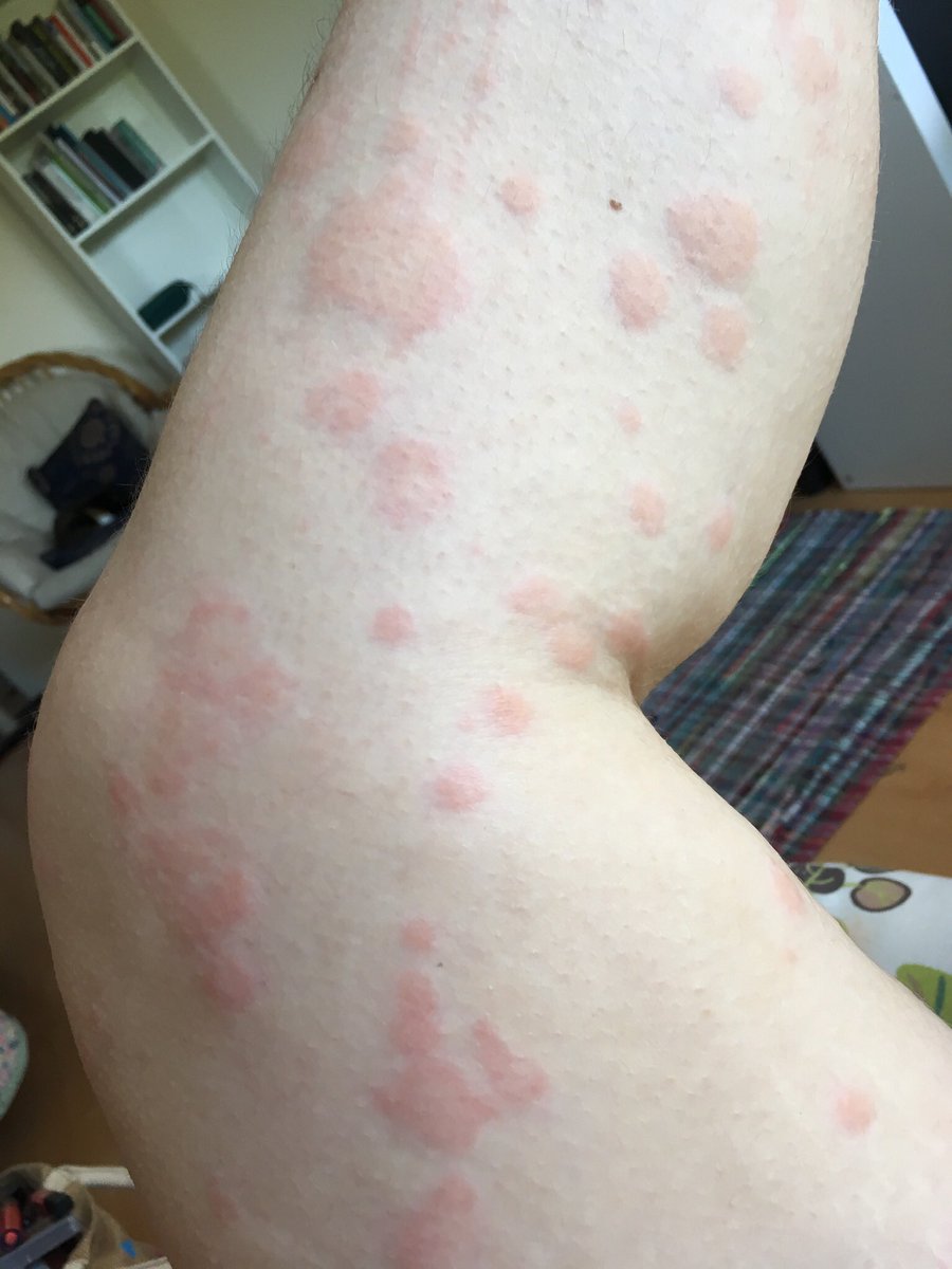 I went to stay with my mum, out of necessity. I needed to be looked after because I was unable to care for myself. The picture of my hand is how swollen my fingers were while travelling. I had to carry a damp flannel to ease the itching. I was delirious.