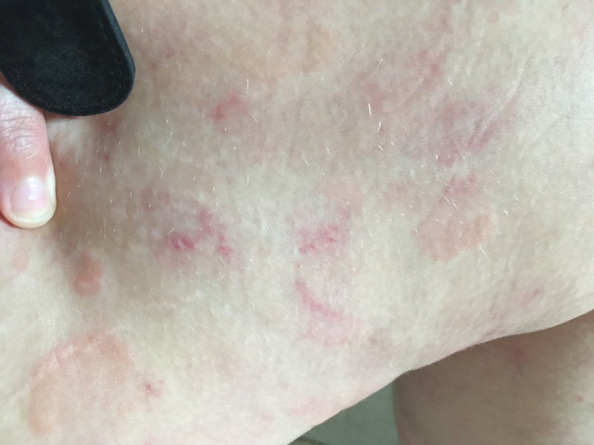 I went to stay with my mum, out of necessity. I needed to be looked after because I was unable to care for myself. The picture of my hand is how swollen my fingers were while travelling. I had to carry a damp flannel to ease the itching. I was delirious.