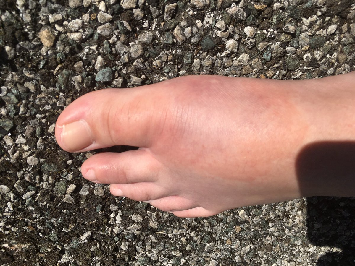 Then it got really bad. Large parts of my body became rock hard, red, swollen, with a deep deep itch and skin that felt sunburnt. The entirety of my thighs, my neck, and most of my sides. My lips and eyes swelled. I had to go to A&E.