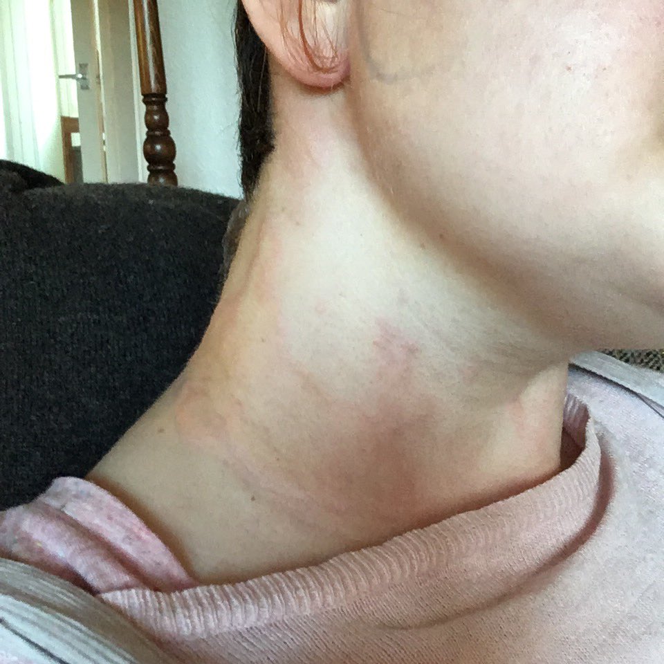 Then it got really bad. Large parts of my body became rock hard, red, swollen, with a deep deep itch and skin that felt sunburnt. The entirety of my thighs, my neck, and most of my sides. My lips and eyes swelled. I had to go to A&E.