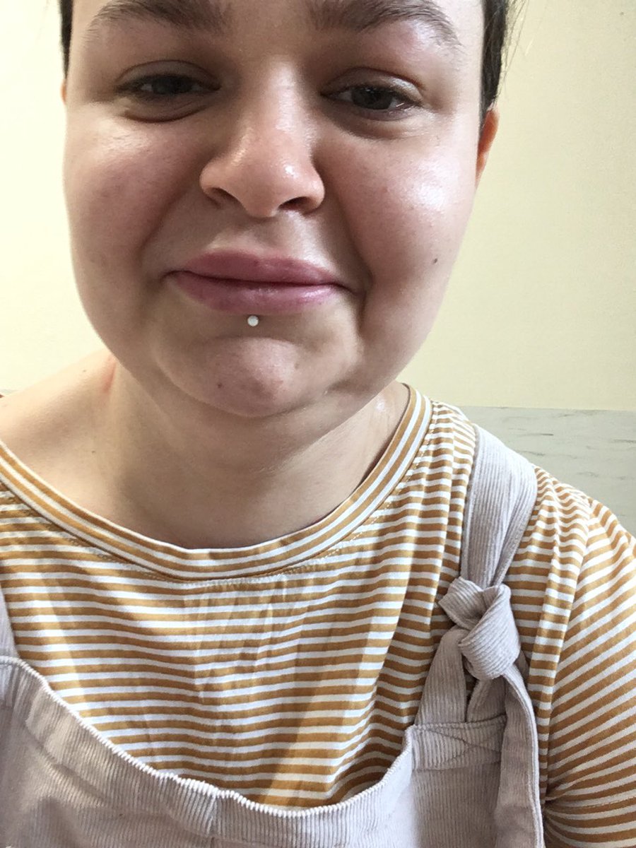 Then it got really bad. Large parts of my body became rock hard, red, swollen, with a deep deep itch and skin that felt sunburnt. The entirety of my thighs, my neck, and most of my sides. My lips and eyes swelled. I had to go to A&E.