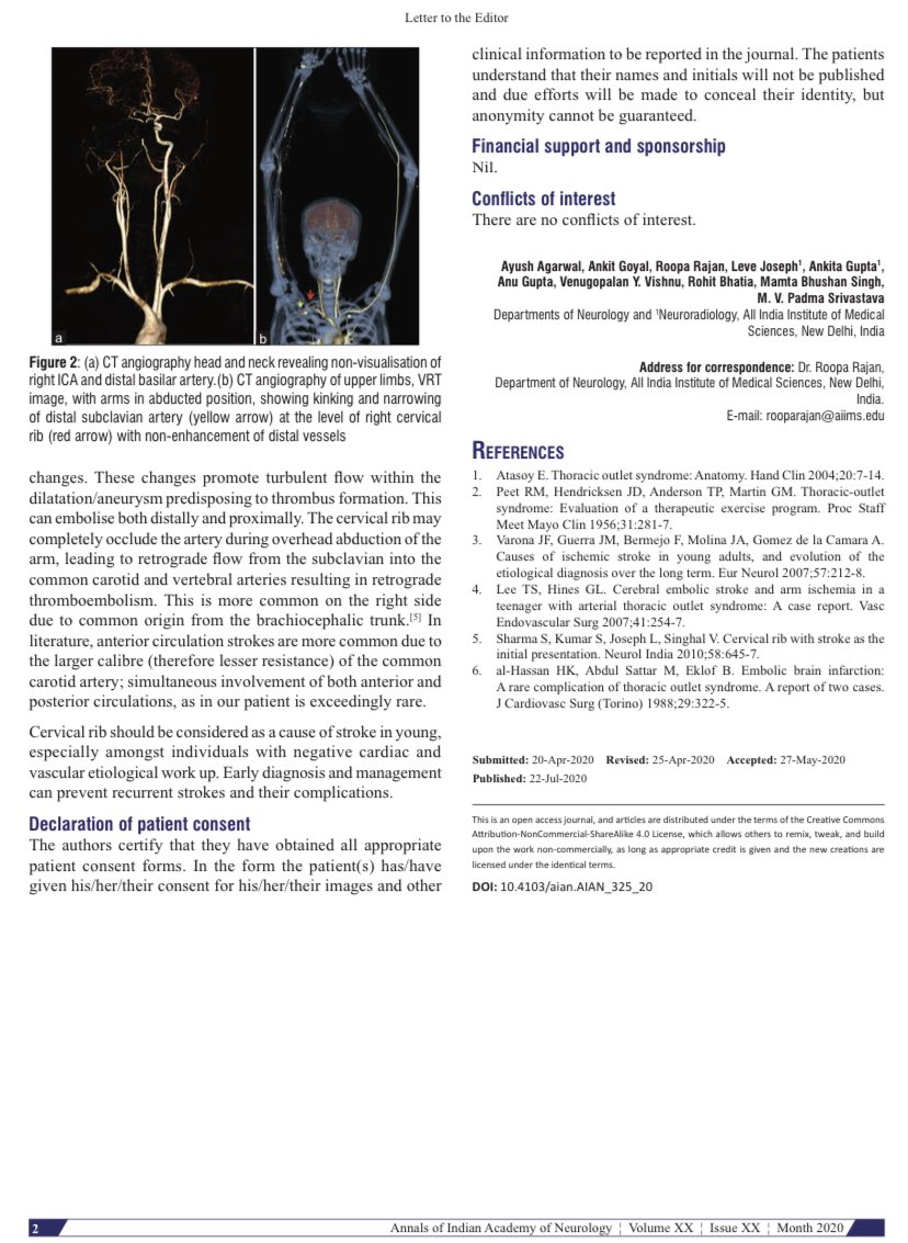 AIIMS_Neurology (@aiimsneurology) on Twitter photo Cervical rib and Recurrent Stroke in Young! <a href="/drayushagarwal/">Ayush A</a> <a href="/rajan_roopa/">Roopa Rajan</a> <a href="/Anu_Gupta_AIIMS/">Anu Gupta</a> @AcademyofNeuro1 #neurotwitter #stroke #youngstroke #medtwitter <a href="/WStrokeCampaign/">WorldStrokeCampaign</a> <a href="/WorldStrokeOrg/">World Stroke Org</a> Cervical rib and Recurrent Stroke in Young! <a href="/drayushagarwal/">Ayush A</a> <a href="/rajan_roopa/">Roopa Rajan</a> <a href="/Anu_Gupta_AIIMS/">Anu Gupta</a> @AcademyofNeuro1 #neurotwitter #stroke #youngstroke #medtwitter <a href="/WStrokeCampaign/">WorldStrokeCampaign</a> <a href="/WorldStrokeOrg/">World Stroke Org</a>