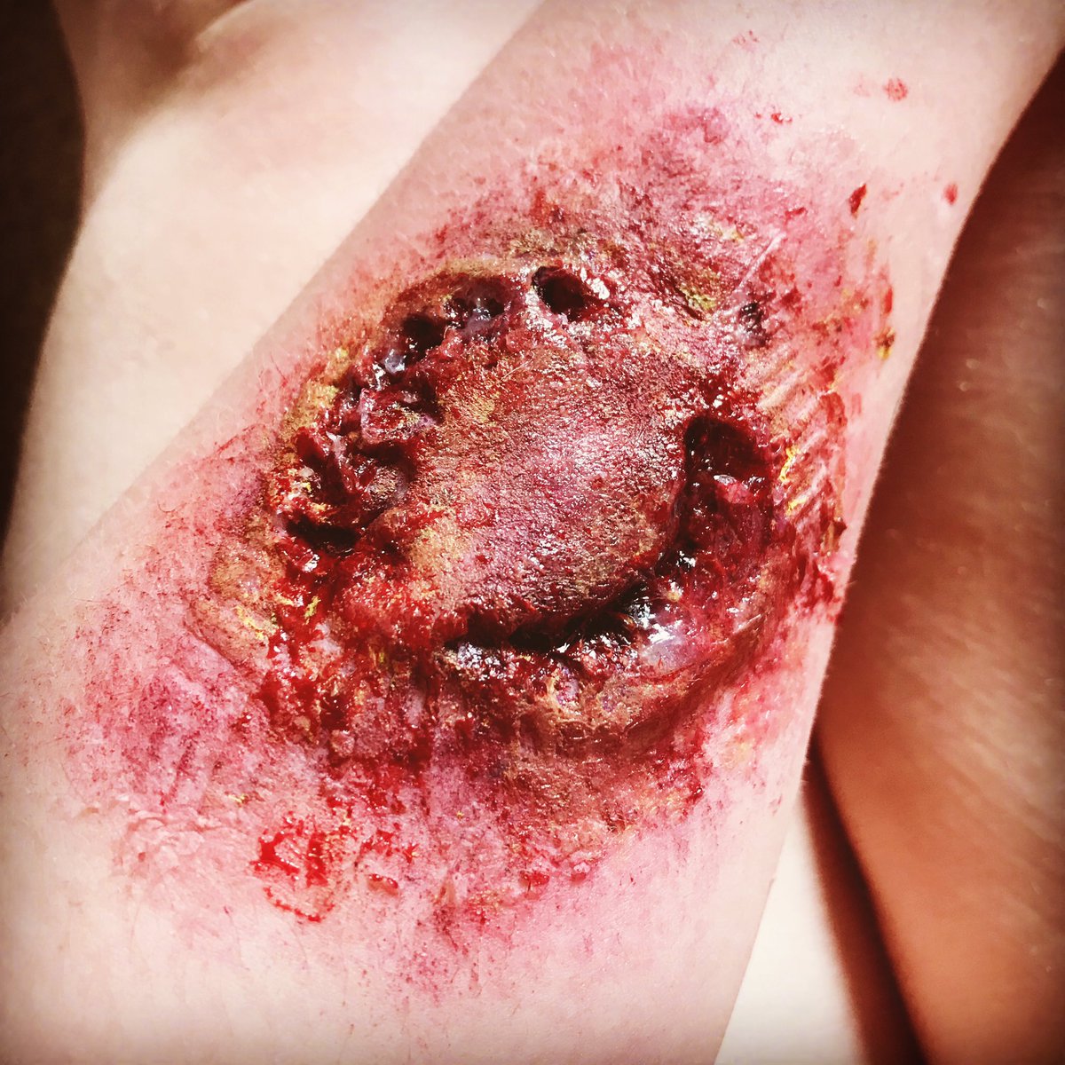 Zombie bite, made incisions with my own teeth to make it as accurate as possible #Zombie #Zombiebite #apocalypse #Virus #SFX #Specialfx #Movie #Gore #Infection