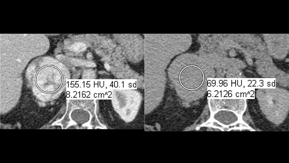 Hypervascular metastases can satisfy washout CT criteria for and therefore be misdiagnosed as benign adrenal adenoma. Understand and avoid this and other pitfalls encountered in adrenal imaging. bit.ly/30glqOt #GURad #CTRad