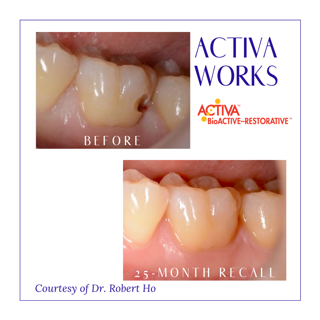 PulpdenTweets's tweet photo. #ThrowbackThursday to this fabulous ACTIVA BioACTIVE-RESTORATIVE case! Courtesy of Dr. Robert Ho.

If you would like to have your clinical images using any Pulpdent product shared, please email leahberk@pulpdent.com  

#TBT #ACTIVAWORKS #ACTIVA #ACTIVABioACTIVE #Dentistry https://t.co/D40LzDbYN3