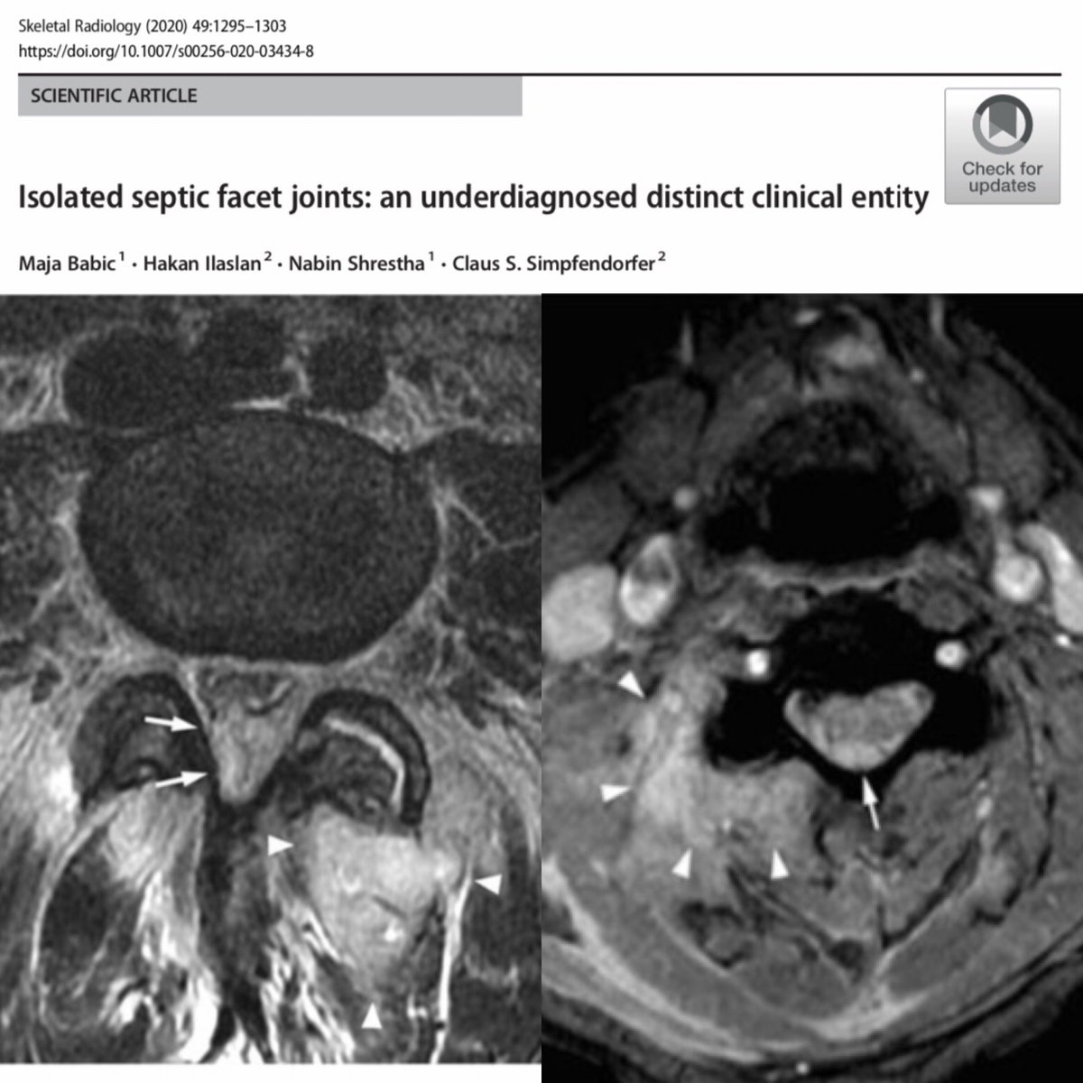 SkeletalRadiol's tweet photo. Isolated septic facet joints: an underdiagnosed distinct clinical entity by Babic et al. #SepticFacetJoint #FacetJointInfection #EpiduralAbscess #Spondylodiscitis #MRI

https://t.co/8DsJrSMvRb https://t.co/serNJSBYmy