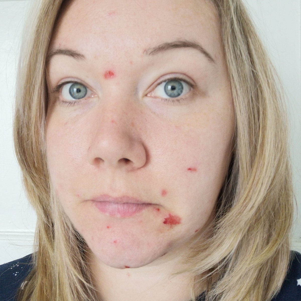 Due to facemasks I'm now struggling with a mast cell reaction. Trust me it freakin' hurts and I'll still not going to use my exemption because I CAN manage and because truly anxious people will do whatever they can to be able to wear a mask. We don't want to be different-5