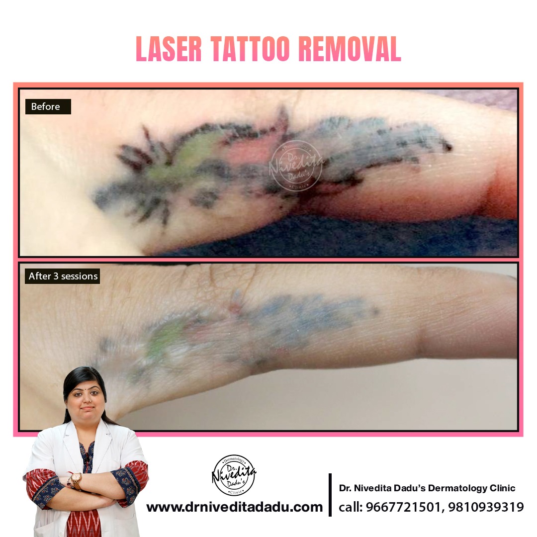 Laser Tattoo Removal How Many Sessions Does It Take  Paradise Med Spas  of Texas