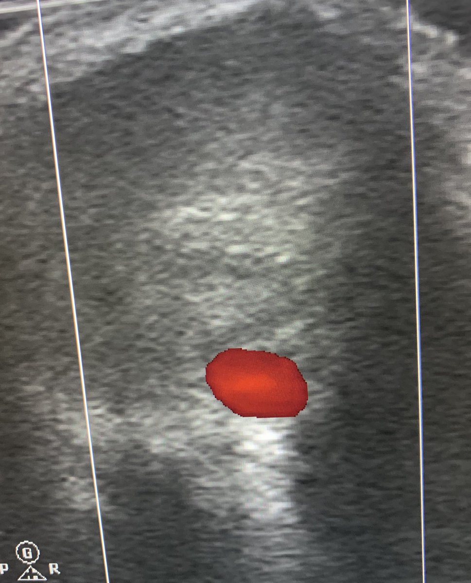 One of the satisfying moment in #irad is when you see the swirl of thrombin storm filling radial a pseudoaneurysm <a href="/BSIR_News/">The British Society of Interventional Radiology</a> <a href="/PAISMedia/">PAISMedia</a>