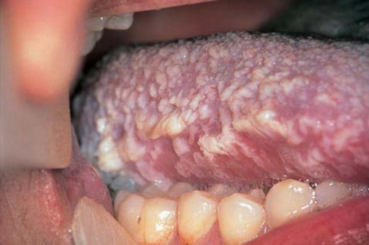 Uremic Stomatitis

#Dental_by_Hadeel https://t.co/XxRl4mjOzl