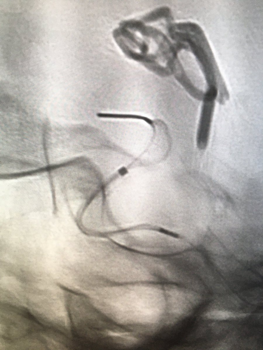 drpaulbhogal's tweet photo. ICA spasm is the hardest to treat with stents. But the Cascade from @PerflowM did a great job in this case! The next frontier is here - time for early diagnosis with TCD, NIRS etc. #stents4spasm @VladoKZg @eytanraz @AntonioLR81 @_AdnanSiddiqui @RLHINR @AlexanderSirak1 https://t.co/pI9iUichpc