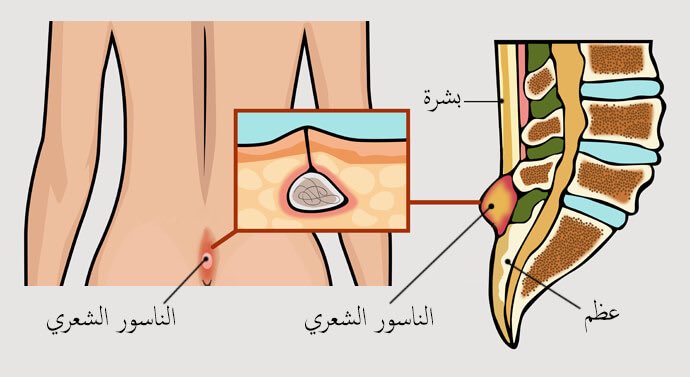 التهاب الغدد العرقية