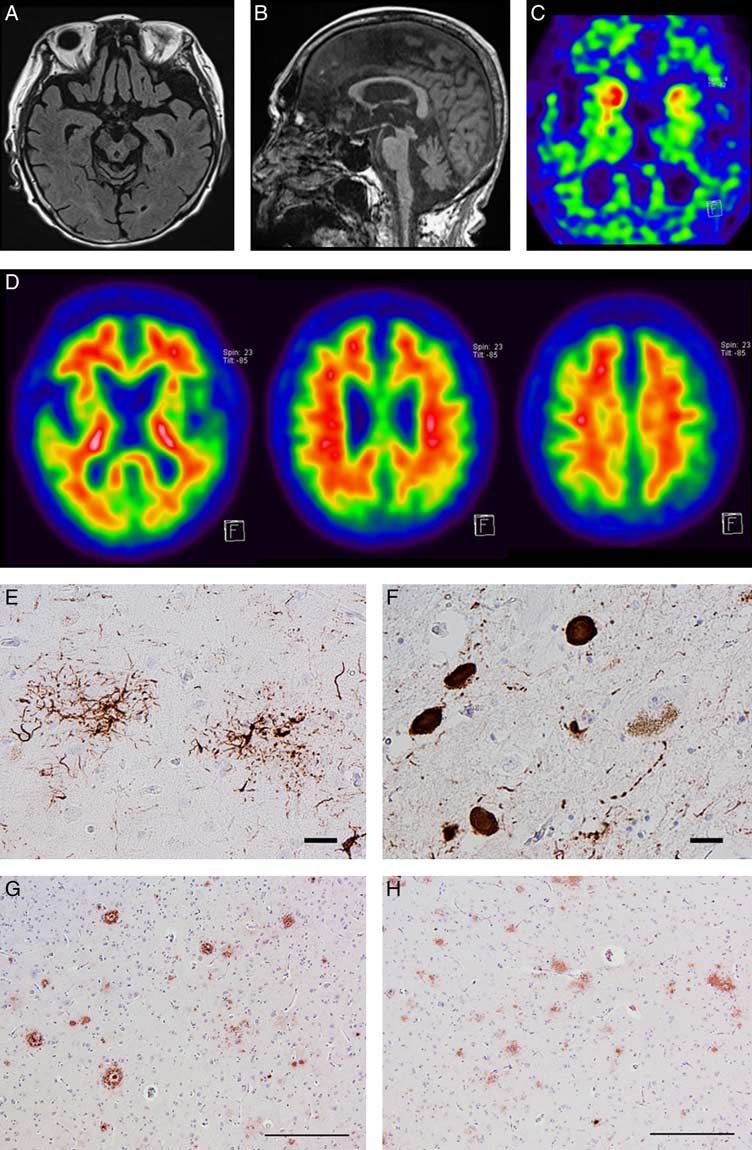 Comparison of Amyloid in Cerebrospinal Fluid, Brain Imaging and Autopsy in a Case of PSP. Case with antemortem CSF Aβ1-42 (+)/amyloid PET (-) may indicate CSF Aβ1-42 is more sensitive for assessing in vivo Aβ than amyloid PET. bit.ly/2ZKPiDI @SalvoSpinaSF