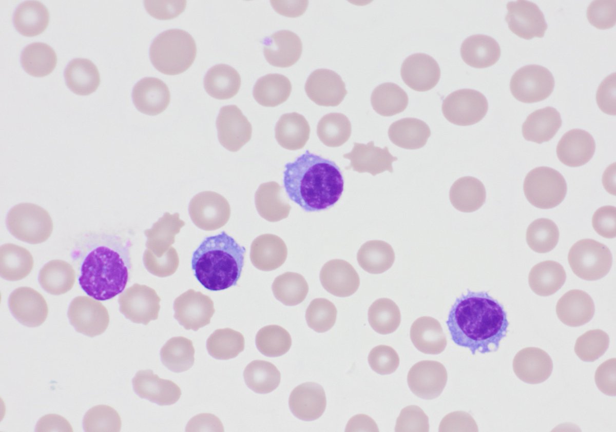 UCSFHemepath's tweet photo. Our first #ucsfHCOW - #hemepath case of the week! 

You are asked to review a peripheral smear from a middle-aged patient with no significant PMH.  CBC shows Hb 8.7, WBC 32.5, platelets 41. The cells shown are ~30%. https://t.co/RRupf0BIcO