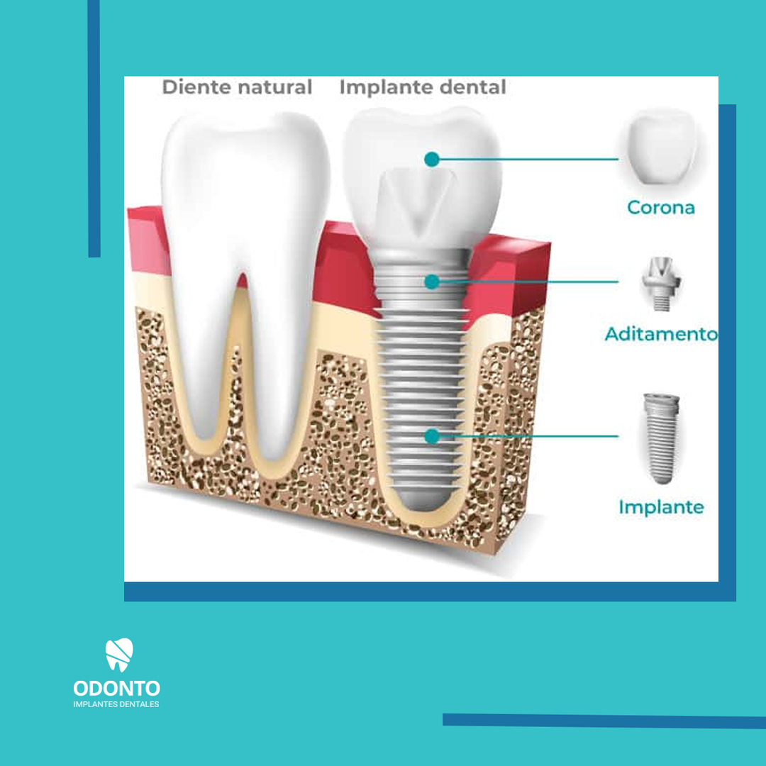 odontoarg's tweet photo. Los implantes dentales, por una serie de razones, son posiblemente el mejor tratamiento para las personas que han sufrido una pérdida dental.#implantesdentales #clinicadentalargentina #odonto https://t.co/uWD2aV4sxn